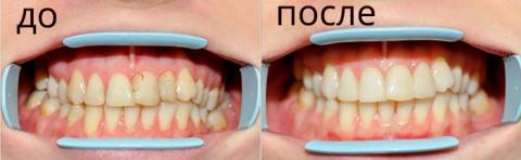 Фторирование зубов (реминерализующая терапия)